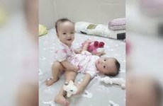 胡志明市儿童医院成功实施连体婴儿分离术 