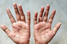 越南卫生部提出六大预防猴痘措施