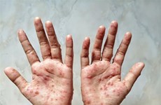 柬埔寨猴痘病例呈增加趋势