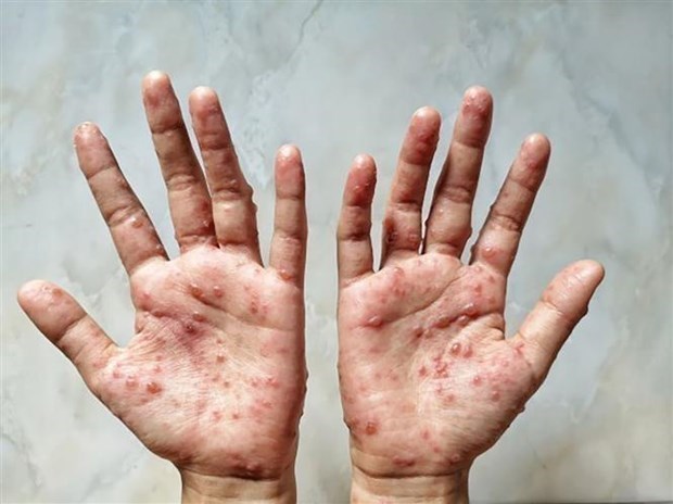 印尼卫生部呼吁国民面对猴痘疫情保持冷静态度 hinh anh 1